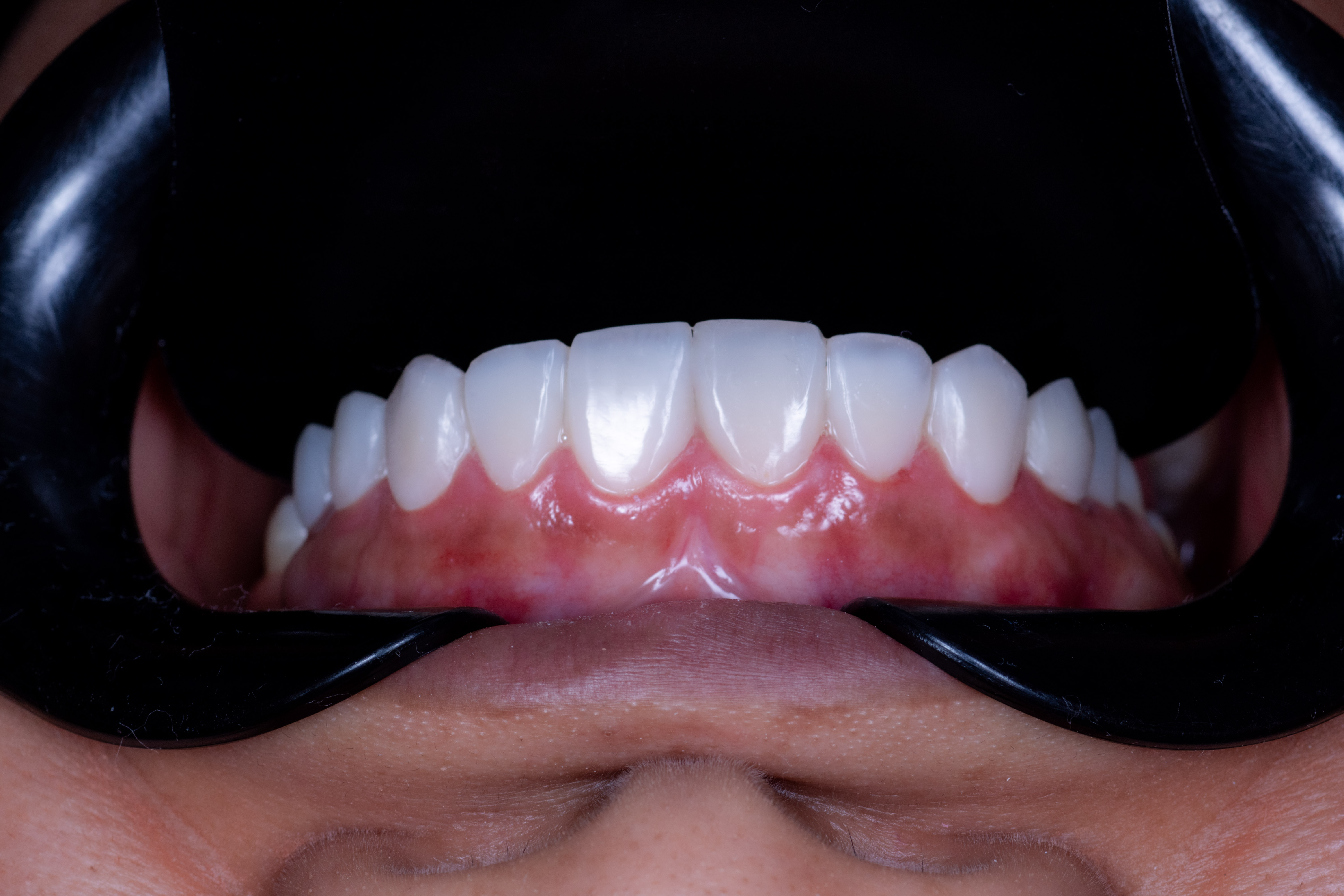 Sorriso depois do tratamento realizado