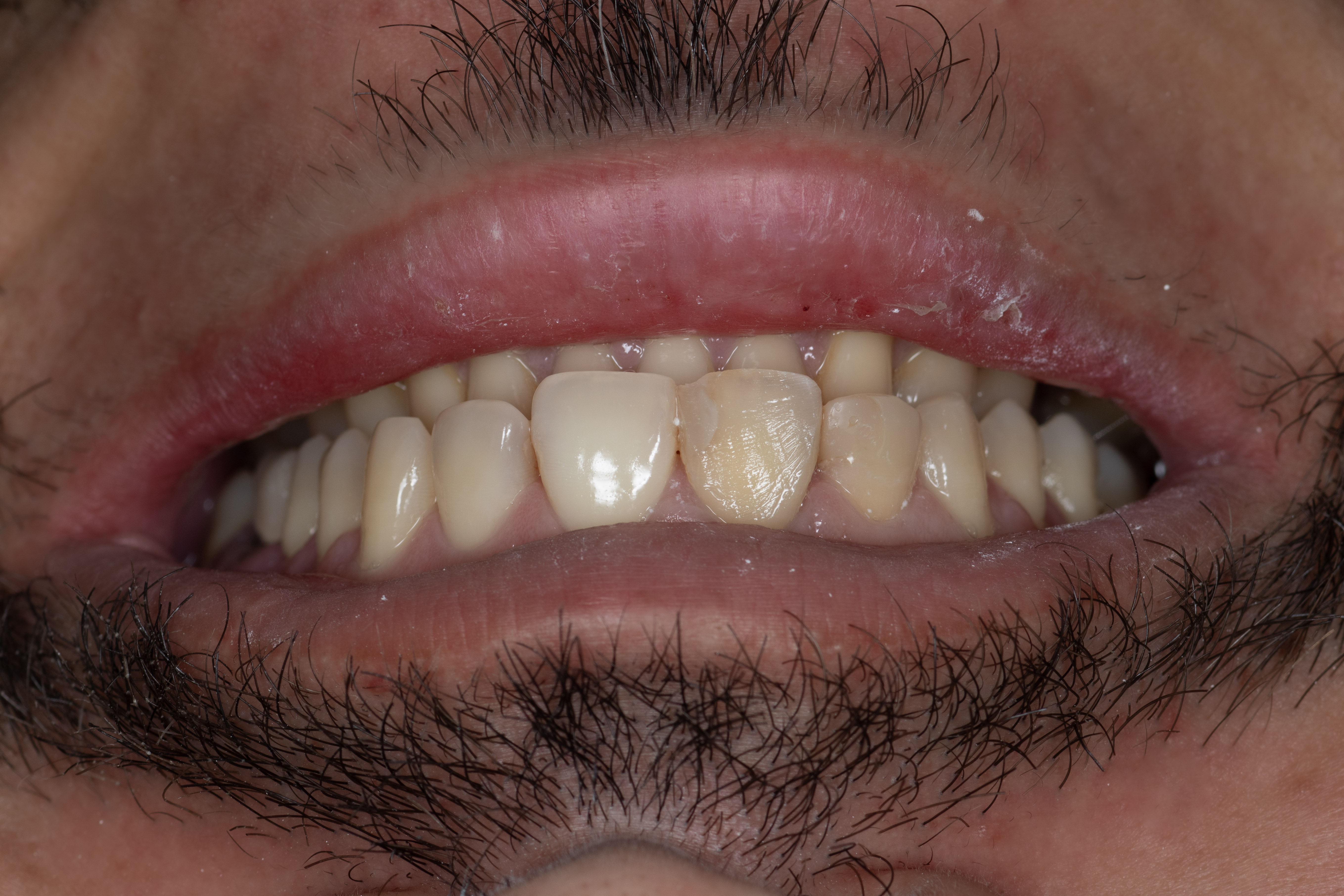 Sorriso antes do tratamento realizado