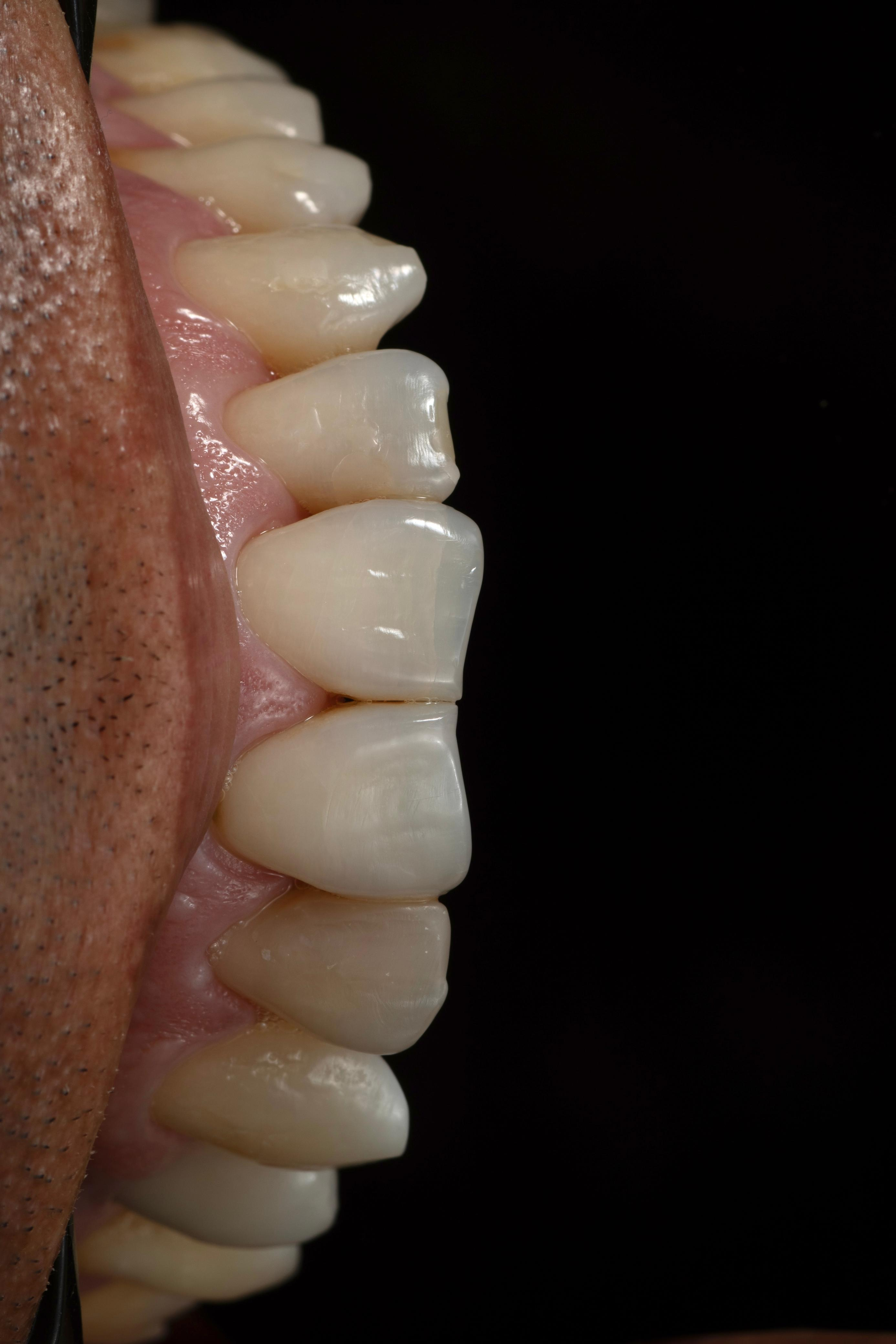 Detalhe lateral do sorriso antes do tratamento