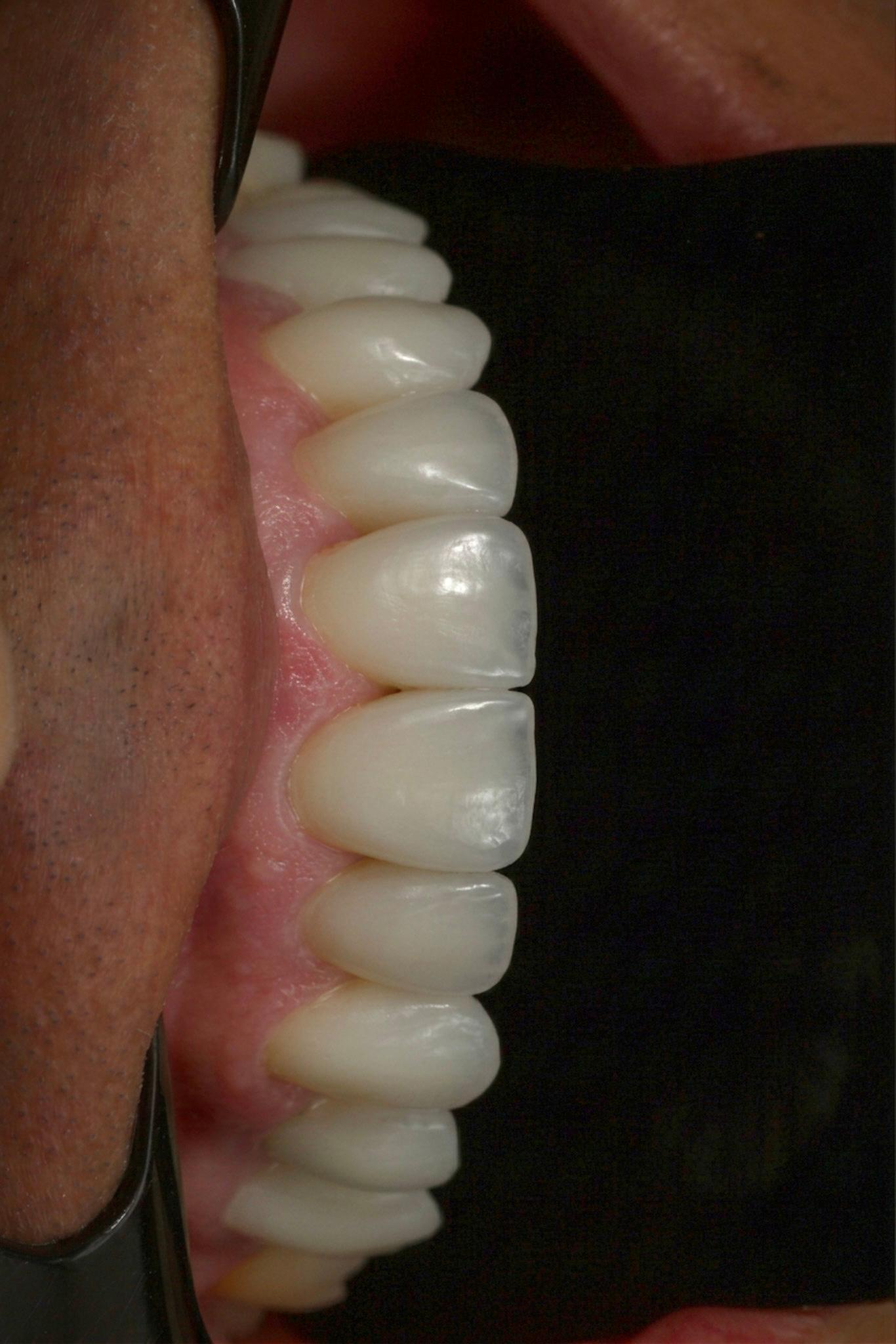 Detalhe lateral do sorriso depois do tratamento