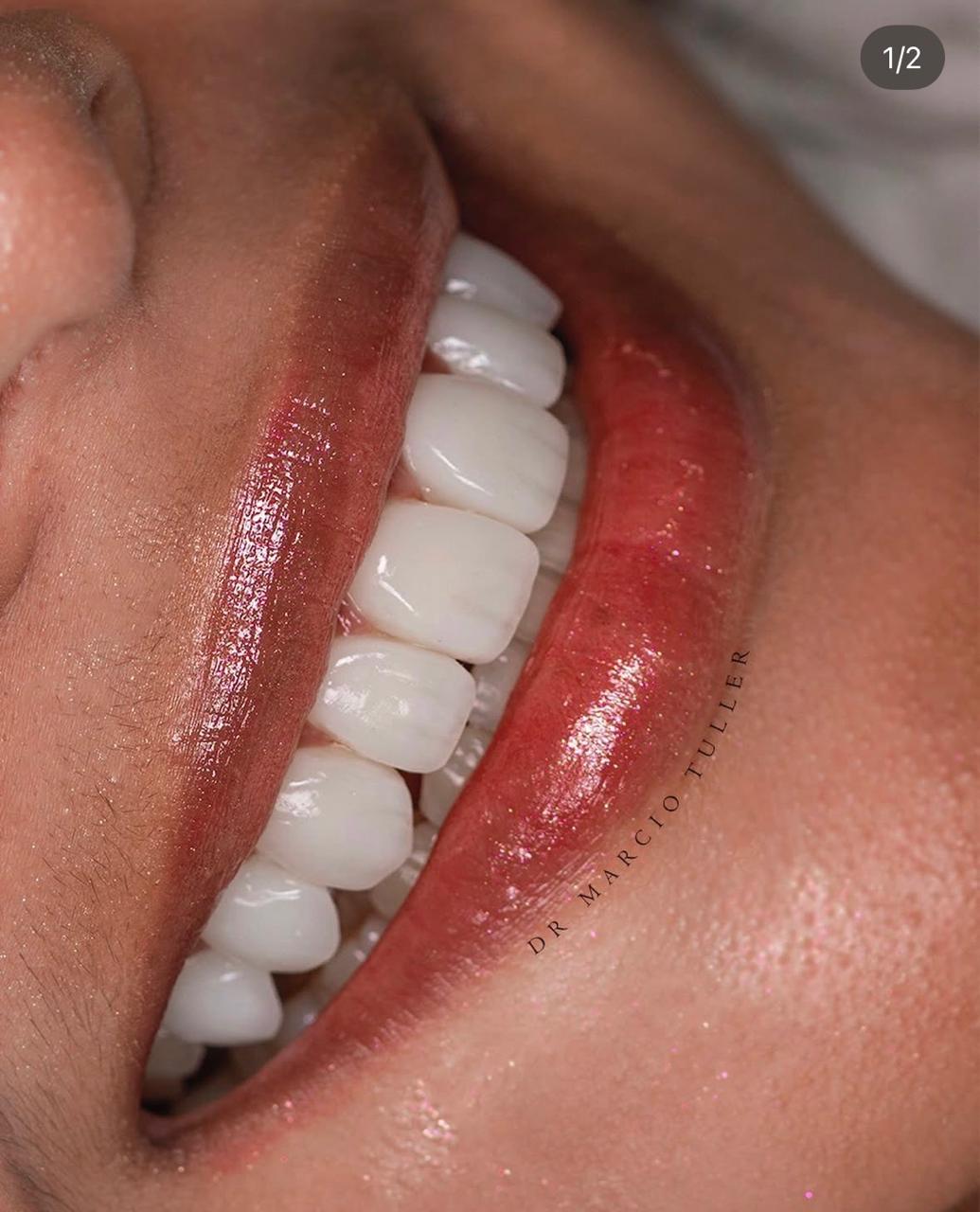 Sorriso em detalhe após tratamento odontológico